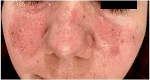 Image result for Pemphigus