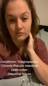 Intestinal Obstruction X Ray Story Fern