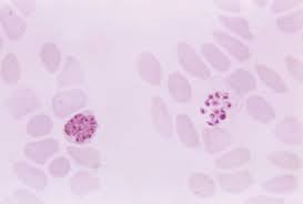 Image result for Malaria