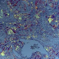 Why is the microscope slide flamed after washing and drying and before smear preparation? Congo Red Stain Recipe