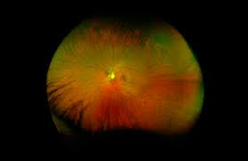 The optomap® retinal exam produces an image that is as unique as you fingerprint and provides us with a wide view to look at the health of your retina. Optos The Difference In Retinal Imaging Eyes Of Claremont