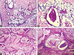 Mucoepidermoid carcinoma (mec) is the most common type of minor salivary gland malignancy in adults. Jaypeedigital Ebook Reader