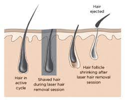 Avoid sunless tanning products for 7 days before treatment. What Is Laser Hair Removal