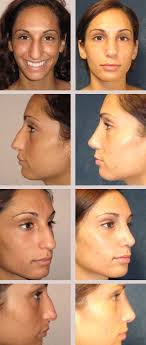 Kotu Aci Fazla Dusuk Rhinoplasty Rhinoplasty Nose Jobs Rhinoplasty Surgeon