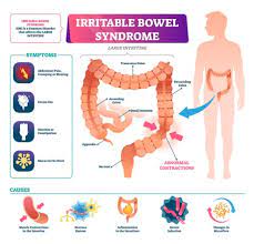 Irritable Bowel Syndrome Treatment Nyc Top Ibs Doctors Ues