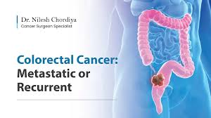 Image result for Colorectal Cancer