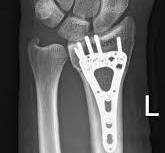 Distal radius fracture - volar locking plate fixation ...