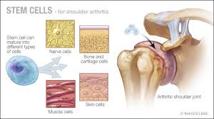 Mayo Clinic Q and A: Stem cell therapy for arthritis - Mayo Clinic News  Network