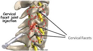 Facet Joint Radiofrequency Stemcelldoc S Weblog