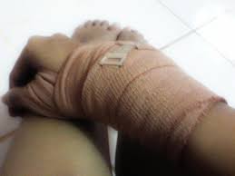 Tersedia dalam berbagai bentuk dan ukuran, perban biasanya digunakan untuk melindungi luka dan pemulihan cedera otot dan sendi. Indonesia Orthopedic Photograph Arts Posts Facebook