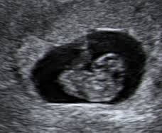 At 8 weeks we would expect to see a tiny baby (approximately 15 millimetres), and we would expect to see a visible heartbeat. You Are 8 Weeks And 3 Days Pregnant Familyeducation