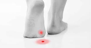 See full list on wikihow.com Plantar Warts Foot Health Clinic Samford Village Qld