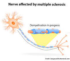 A large number of people with multiple sclerosis develop optic neuritis (inflammation of the optic nerve, which is an extension of the central nervous system), described as a painful vision loss. Multiple Sclerosis Nclex Questions