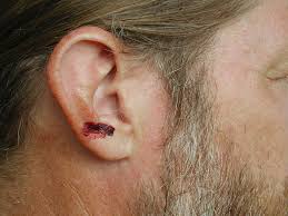 Image result for Bat Bite