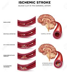 Que es una trombosis arterial. La Formacion De Coagulos De Sangre En La Arteria Cerebral Bloqueo Del Flujo Sanguineo Por El Trombo Anatomia De La Arteria Sana Arterias Saludables Con Aterosclerosis Y Finalmente Coagulo De Sangre Ilustraciones