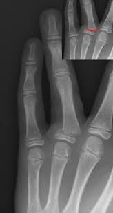 The splint is usually worn for three weeks while the bone heals. Finger Fractures Pacs Suche Fur Radiologen