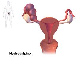 Hydrosalpinx traitement naturel
