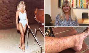 Tanorexic who had a sunbed in her room now has skin cancer