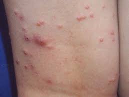 We did not find results for: Molluscum Contagiosum Images Dermnet Nz