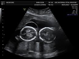 From conception, twins are formed when one of two events happen. 18 Weeks Pregnant With Twins Tips Advice How To Prep Twiniversity