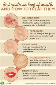 Red Spots On Roof Of Mouth What Are They Roof Of Mouth Sore Sore In Mouth Remedies Canker Sore Remedy