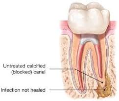 Maybe you would like to learn more about one of these? Endodontic Retreatment Explained American Association Of Endodontists