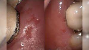 Image result for Canker sores symptoms roof of the mouth