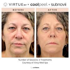 Stomach laxity? Subnovii's got you covered! ⚡️ Huge thanks to  @peakmedicalspa for showcasing how Subnovii Plasma Pen can help tighten  wrinkles and sagging skin