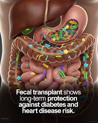 Image result for Fecal Transfer