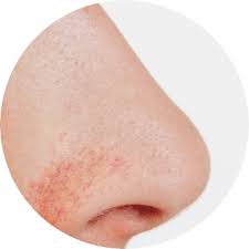 Check spelling or type a new query. Laserbehandlungen Blutgefasse Laseraesthetik Berlin Mitte