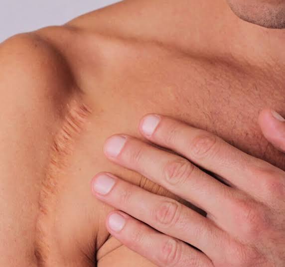 Surgical Scars Treatment Vancouver,WA - NW LASER