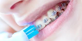 Bahan Ini Cegah Luka Di Mulut Pemakai Kawat Gigi Enzim Toothpaste