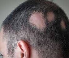 The vitamin is crucial for hair. Alopecia Areata Spot Baldness Associated With 8 5 Ng Lower Levels Of Vitamin D Meta Analysis April 2018 Vitamindwiki
