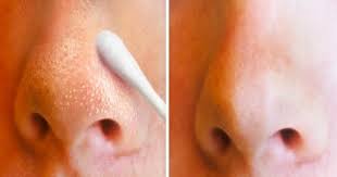 8 Facons Naturelles De Venir A Bout Des Points Noirs Et Des Points Blancs Point Noir Point Blanc Visage Masque Contre L Acne
