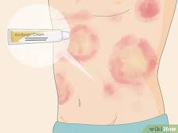 3 Ways To Treat Fungal Rash - Wikihow