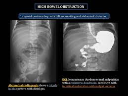 Image result for Midgut Volvulus
