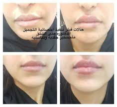 اقوي عروض مجمع اروكا الطبي بالرياض عيادة أسنان بالرياض 0545359682 عيادة جلدية بالرياض تقويم أسنان بالرياض حشو أسنان بالرياض تنظيف أسنان بالرياض تبيض أسنان بالري Nose Ring Septum Ring Septum