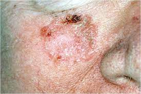 30.11.2017 · these suspicious spots are often pinkish or take on the color of your skin. What Does Skin Cancer Look Like A Visual Guide To Warning Signs Allure
