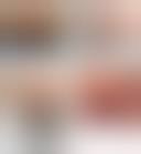 Image result for Rectal prolapse