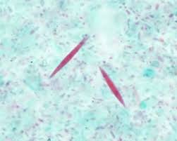 Difference Between Amoebic Dysentery And Bacillary Dysentery Learn Microbiology Online