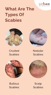 Image result for Scabies