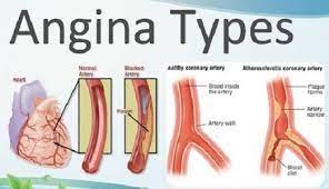 Nabi sulaiman bertemu dengan rihul ahmar (angen merah) dan sejarah doa rihul ahmar. Pertolongan Pertama Pada Gejala Angin Duduk