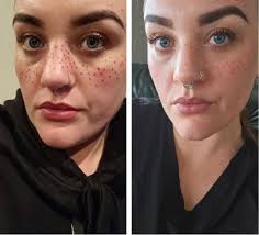 They're so cute': The rise of freckle tattoos