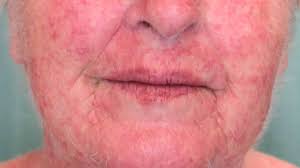The allergic reaction to hair care products is typically on the skin. Allergic Contact Dermatitis Symptoms Causes Pictures And More