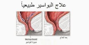 جميع طرق علاج البواسير طبيعيا بدون جراحة التخسيس السريع Hemorrhoids Cure For Hemorrhoids Home Remedies For Hemorrhoids