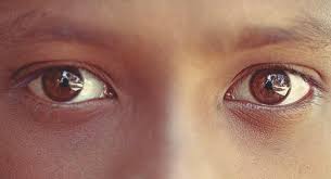 eyelid dermais causes treatment