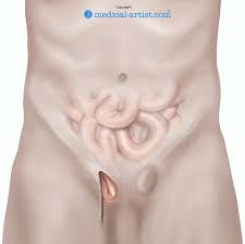 Image result for Inguinal hernia man