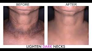 How to get rid of a dark neck at home? Dark Neck Home Remedies How To Get Rid Of Dark Neck Naturally In 5mins Omabelletv Youtube