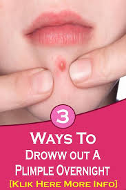 How To Draw Out A Pimple Overnight In 2020 Pimples Overnight Pimples Overnight Pimple Remedies