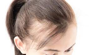 In women, it is also used to treat excessive hair growth. Receding Hairline How To Stop According To Ayurveda Vedix